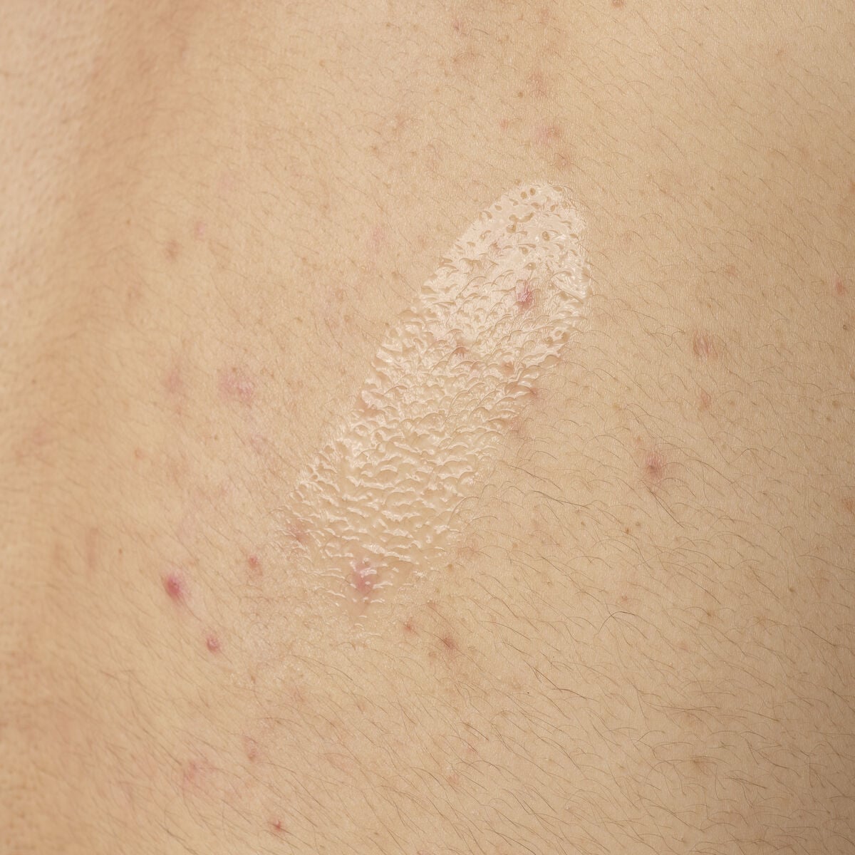 salicylic-acid-0-5-body-serum-d3 ORD-salicylic-acid-05-body-240ml-application.jpg