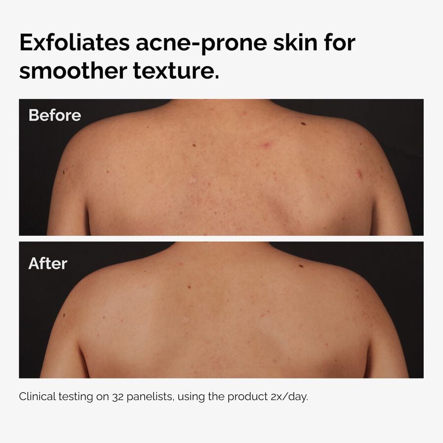 the-body-care-collection-u2 ord-salicylic-acid-body-serum-before-after-graphic-NA.jpg
