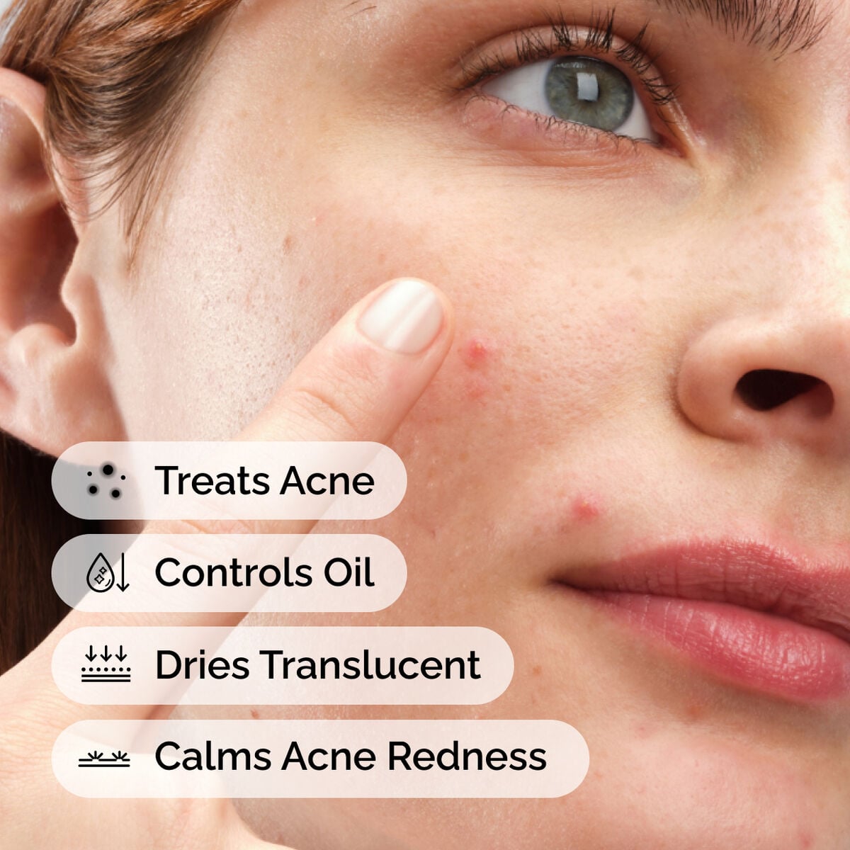 sulfur-10-powder-to-cream-concentrate-v4 ord-sulfur-10pct-powder-to-cream-concentrate-model-application-with-benefits-acne.jpg