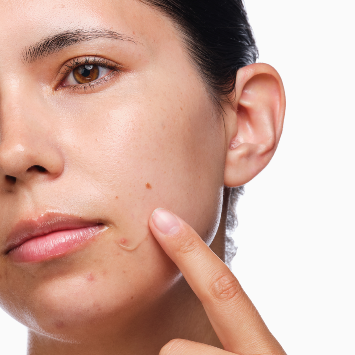 the-acne-set-c1 rdn-the-acne-set-application.png